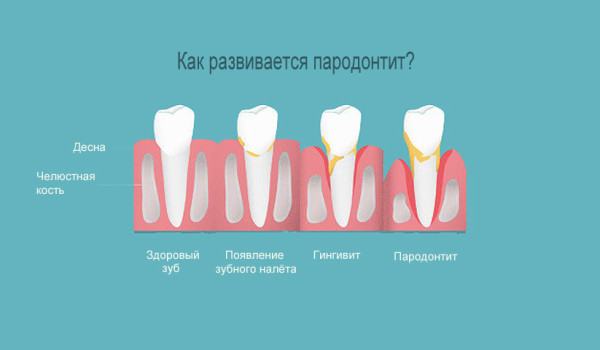 Пародонтит и кариес: как защитить зубы от обеих проблем