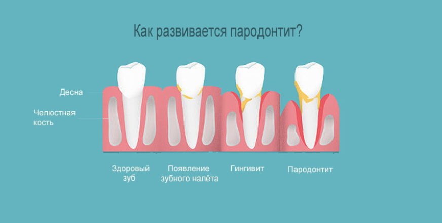 Пародонтит и кариес: как защитить зубы от обеих проблем
