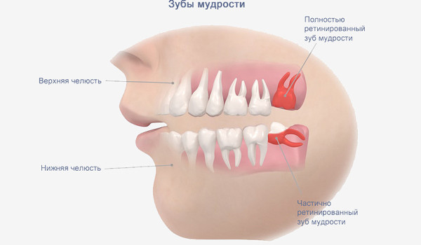 Удаление зуба мудрости: особенности и сложности
