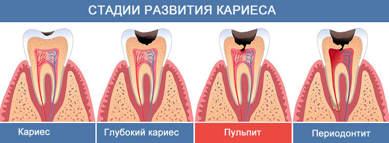 Пульпит как стадия развития кариеса